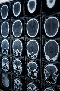 head injury lawyer in Lee's Summit, MO